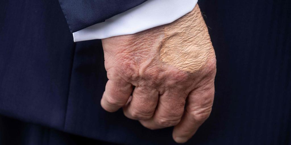 Detectan a Trump hinchazón en las piernas y un moratón en una mano por «estrechar muchas»